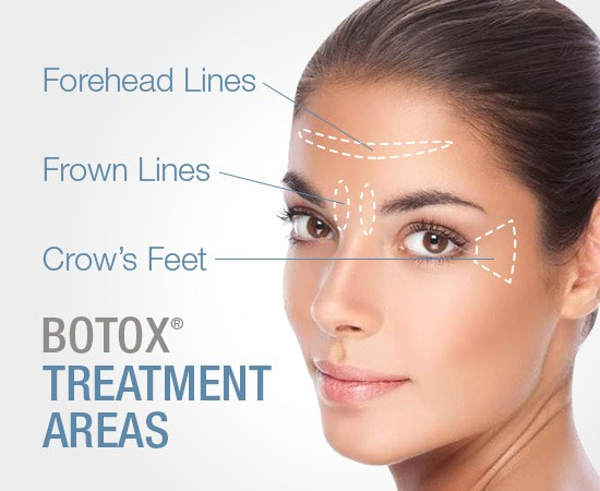 Beautiful female face with overlaid with Botox Treatment Areas graphics