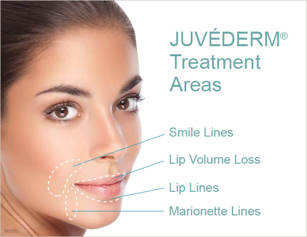 Beautiful female face overlaid with Juvederm Treatment Areas graphics